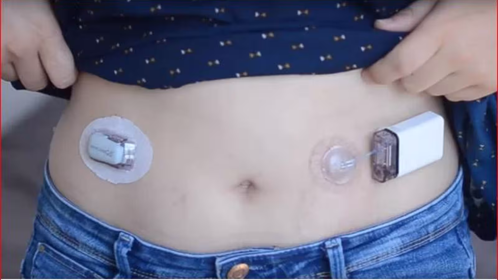 Pancréas artificiel, une prise en charge innovante du diabète à  La Réunion