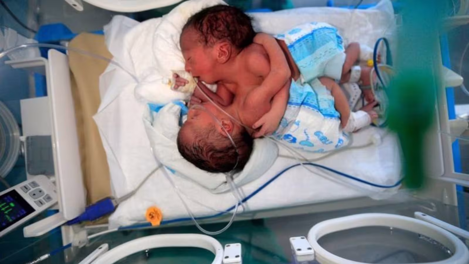Yémen : dans un état critique, deux bébés siamois attendent une opération à l’étranger
