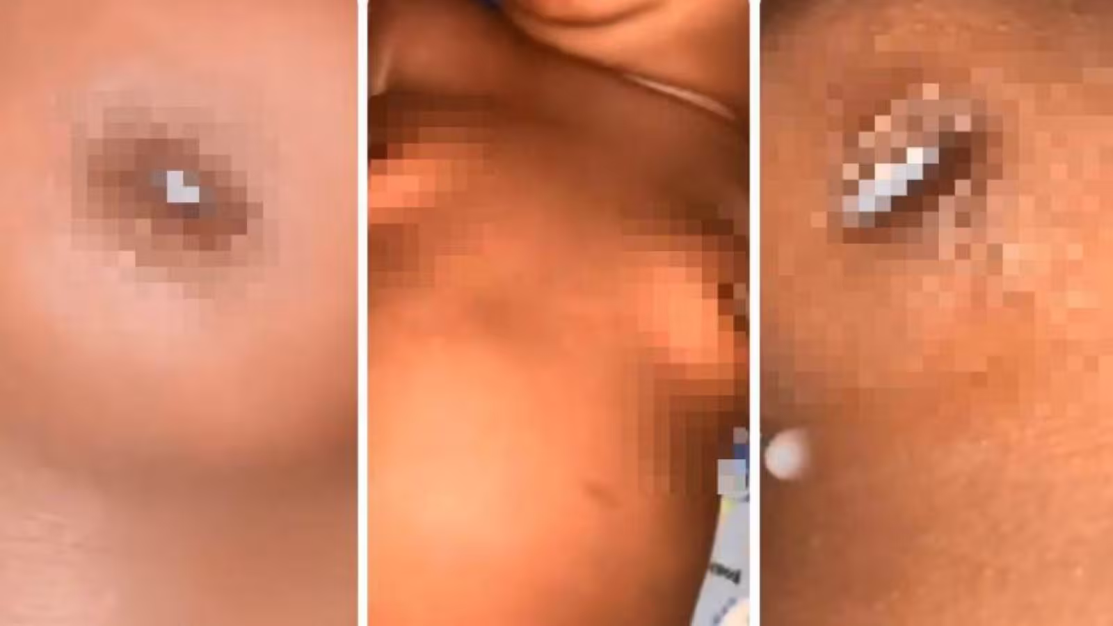 Elle transfère ses hormones à son bébé pendant la grossesse, le petit Kylian naît avec des seins qui allaitent