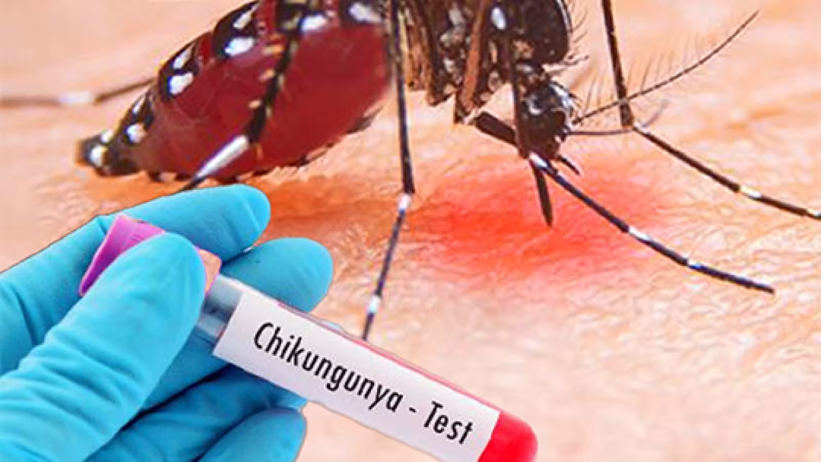 Chikungunya : Deux des six échantillons testés négatifs…les autres résultats attendus ce mardi