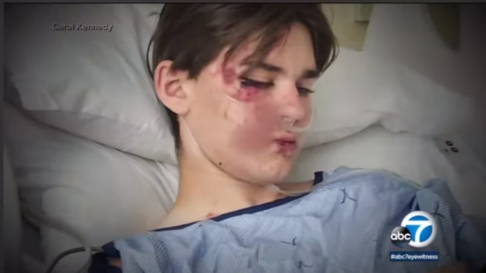 À 14 ans, il chute de 100 pieds dans une gorge et survit