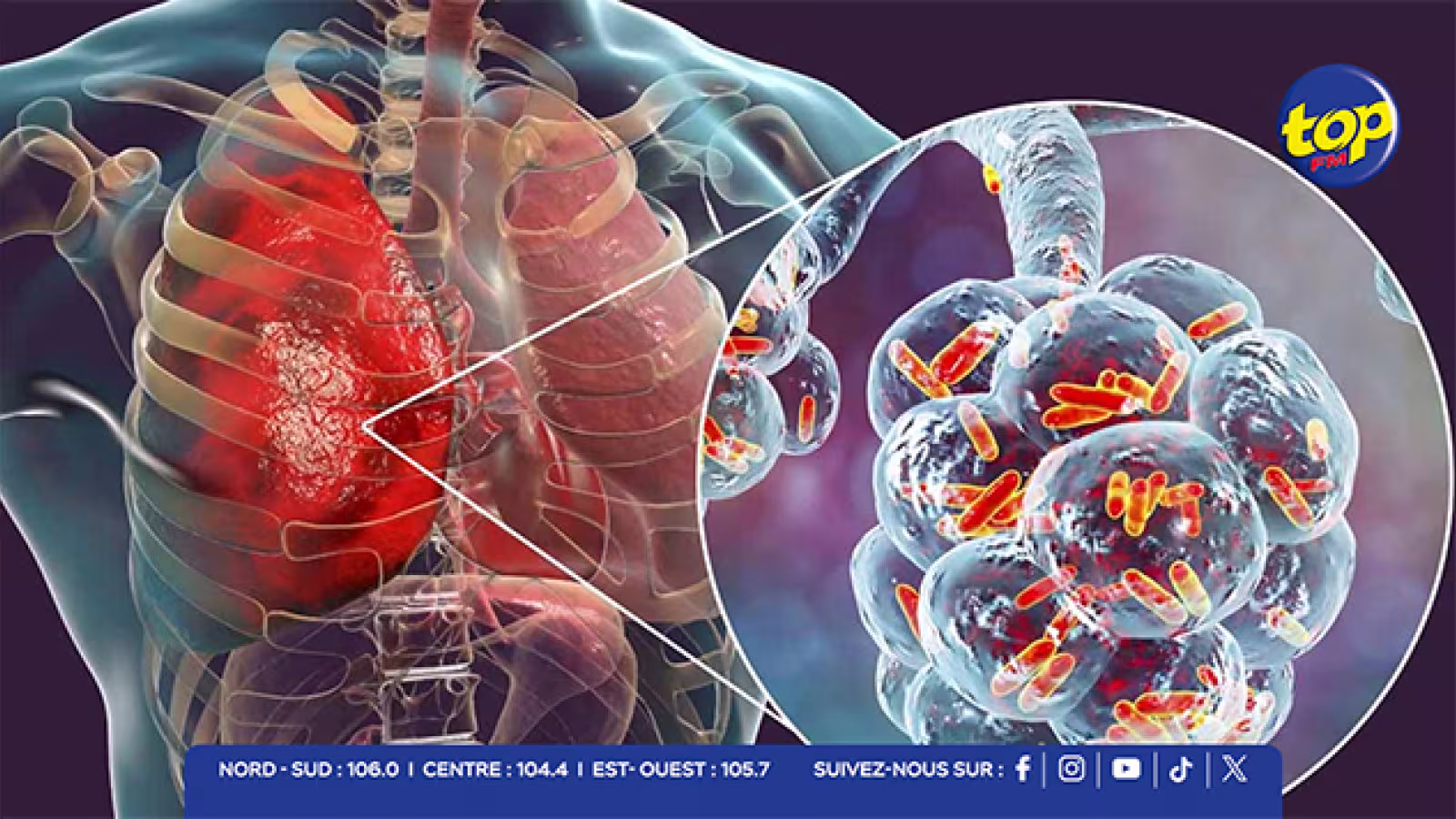 Les cas de grippe et d’infections respiratoires en hausse