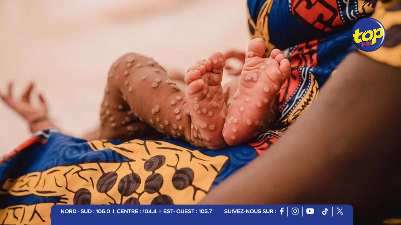 Mpox en Guinée-Bissau : les enfants particulièrement touchés lors de la première flambée dans le pays