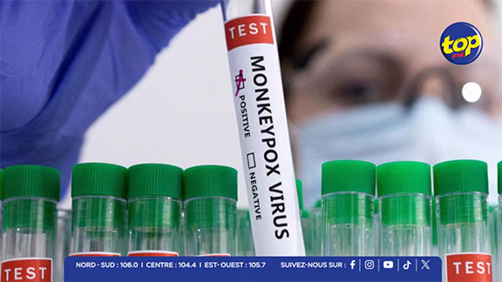 La Réunion : deux nouveaux cas de Mpox détectés, portant le total à 6 depuis le début de l’année