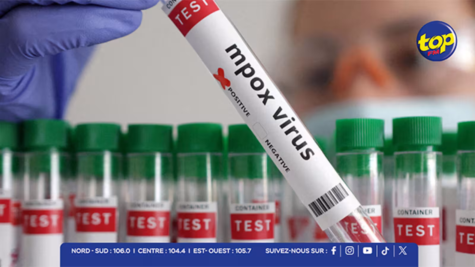 Mpox : toujours 2 cas de transmission locale, l’exercice de Contact Tracing se poursuit