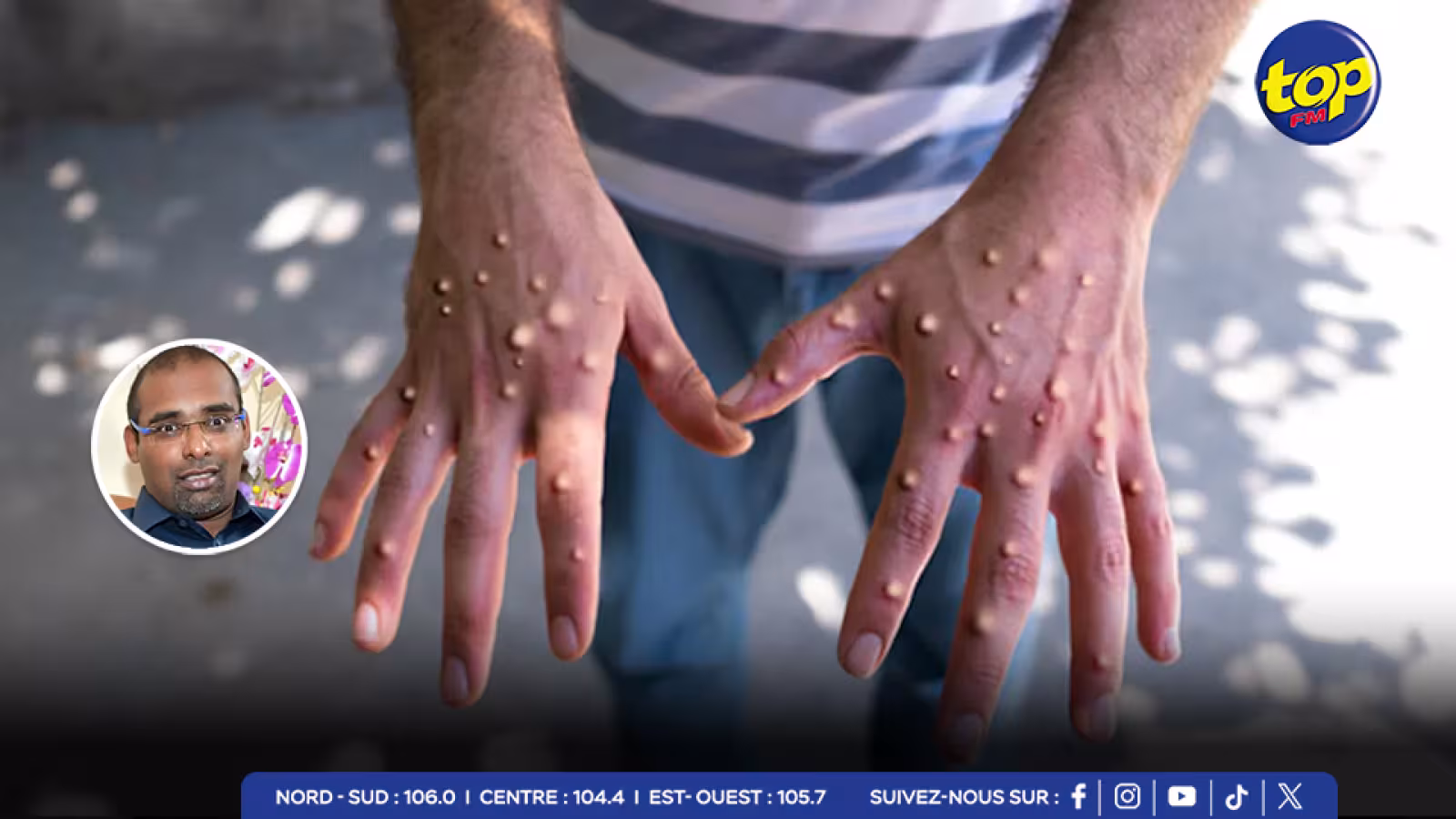 Mpox :