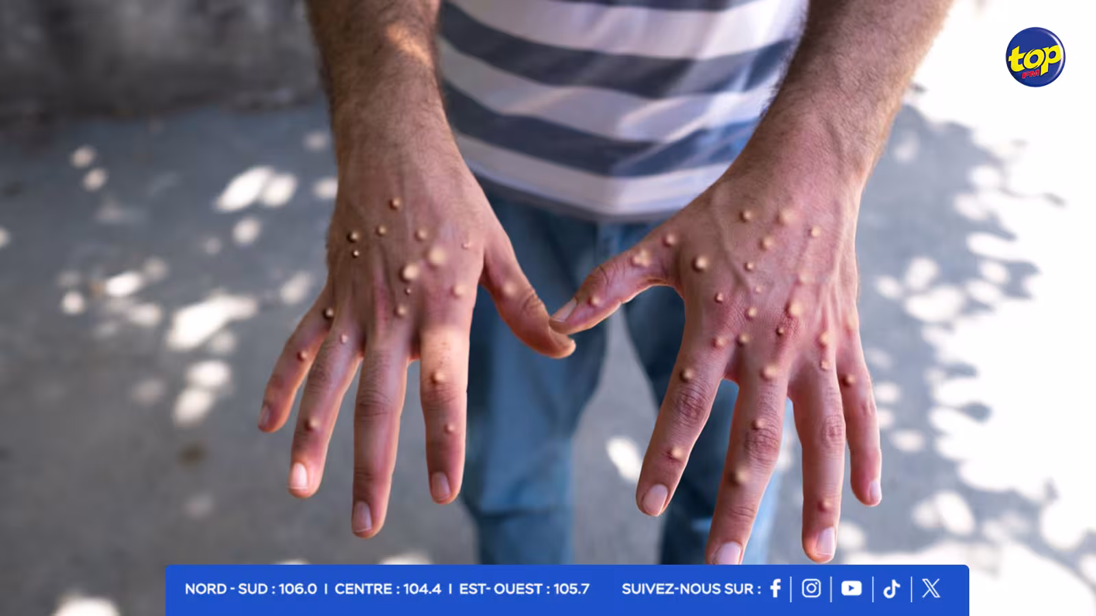 MPOX