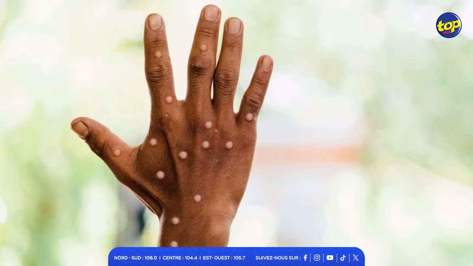 Mpox : Maurice renforce ses mesures de surveillance…Aucun cas détecté à ce jour