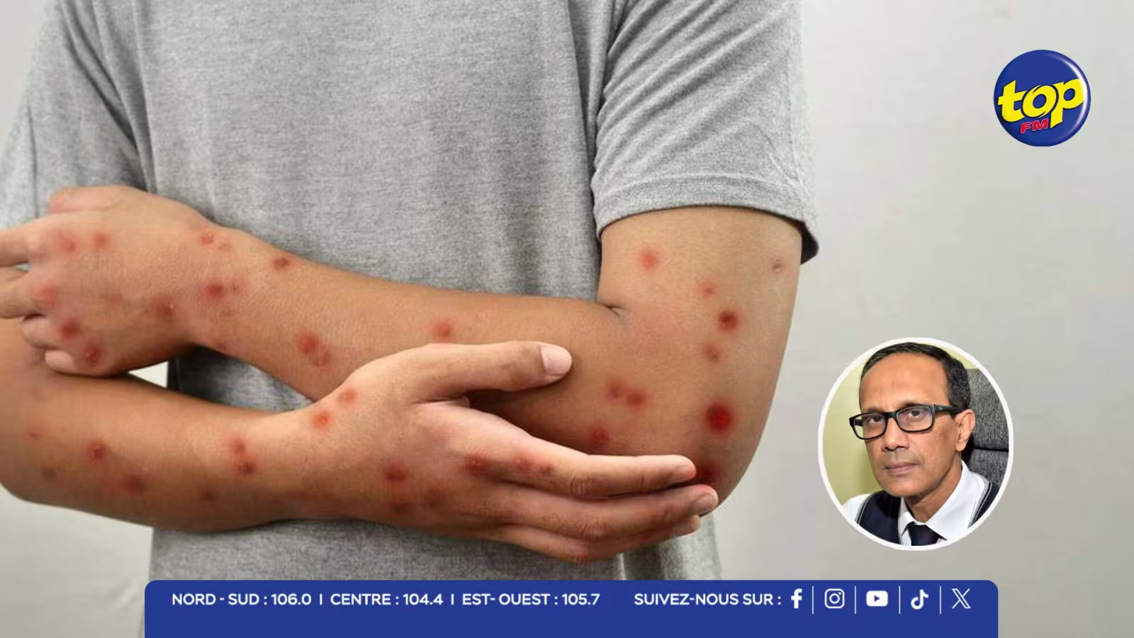 MPOX