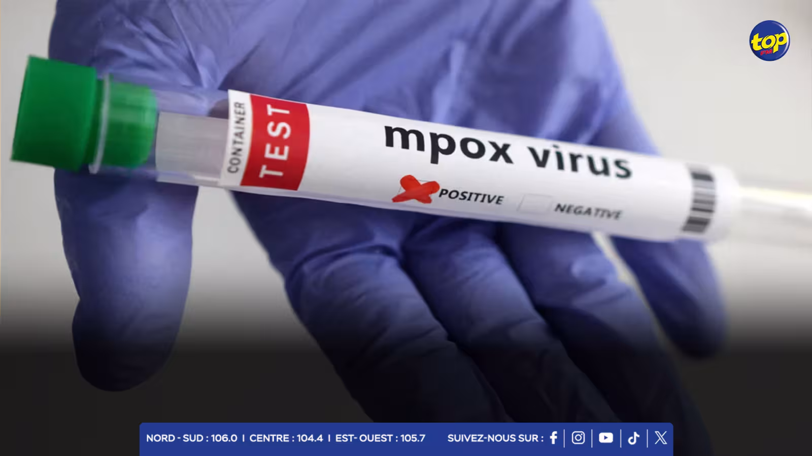 États-Unis : le premier cas connu d’une forme plus sévère de mpox est confirmé en Californie