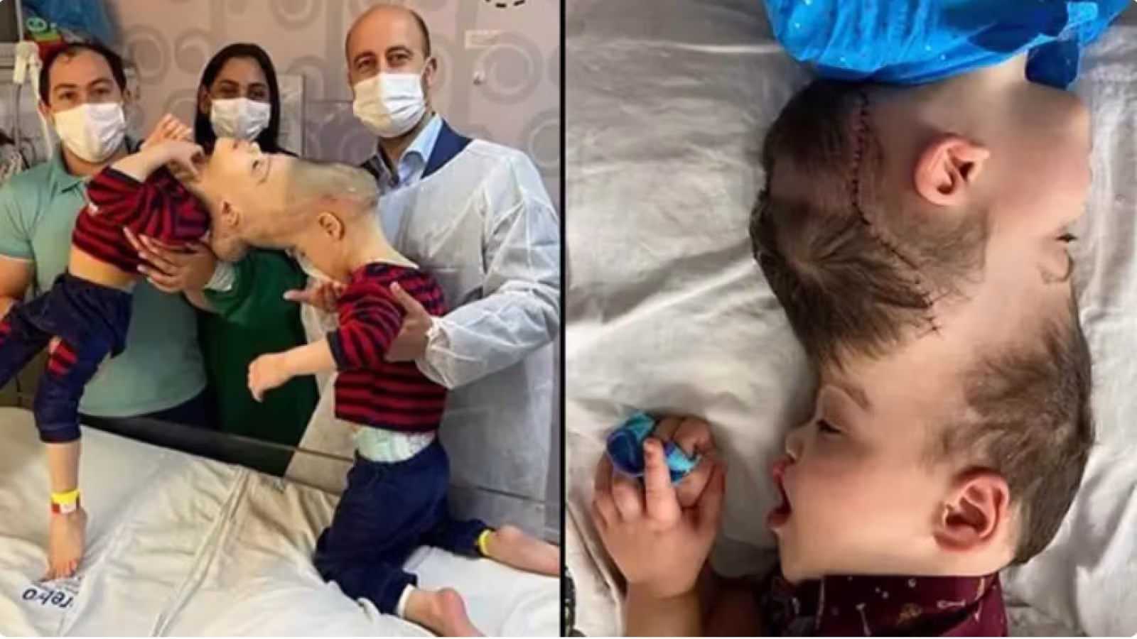 Des jumeaux siamois de 3 ans avec des cerveaux fusionnés séparés lors d’une chirurgie de réalité virtuelle historique