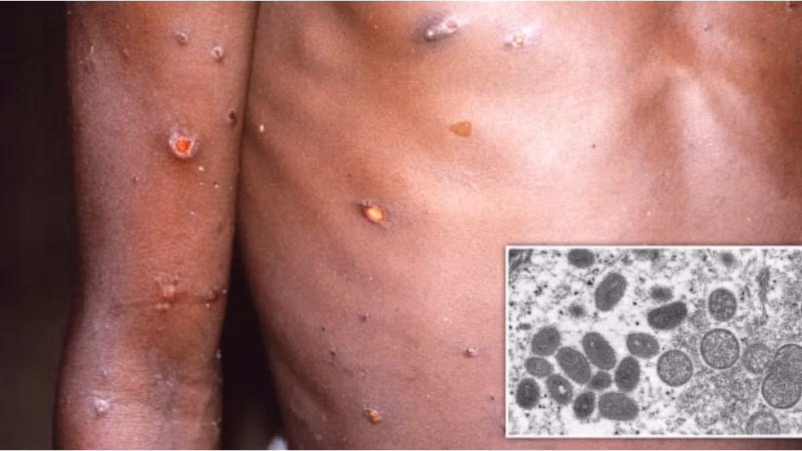 Variole du singe : le seul fabricant de vaccins augmente sa production