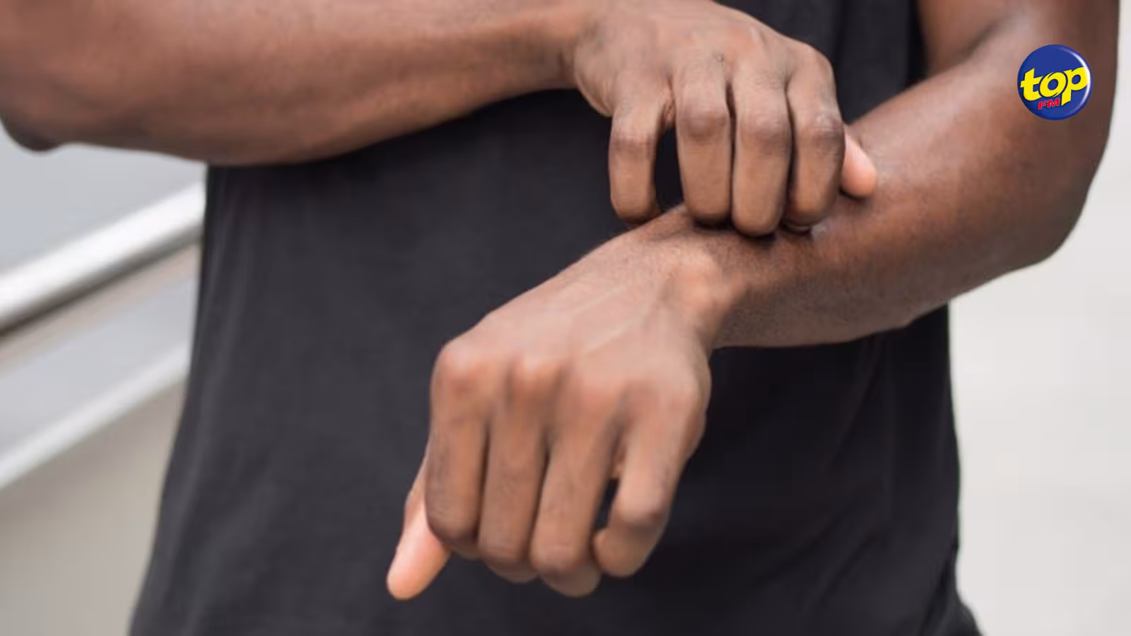Variole du singe : Le ministère de la Santé en présence d’un cas suspect
