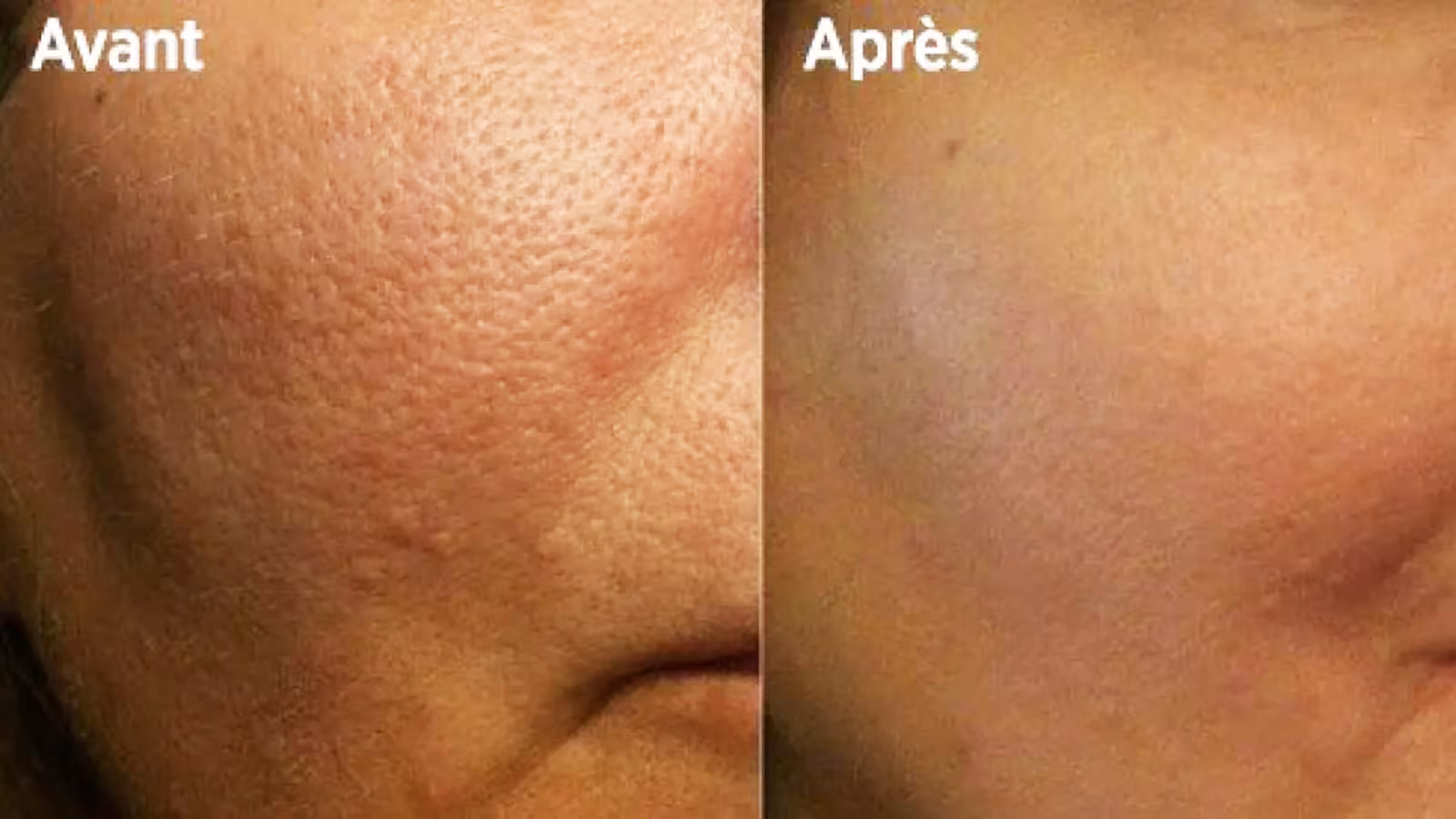 Astuces pour resserer les pores dilatés
