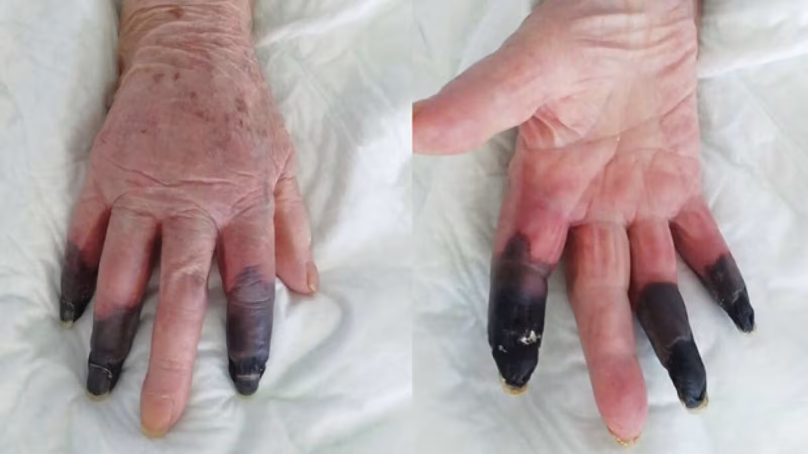 Gangrène, ulcères, éruptions cutanées : le COVID-19 provoque des maladies secondaires mortelles