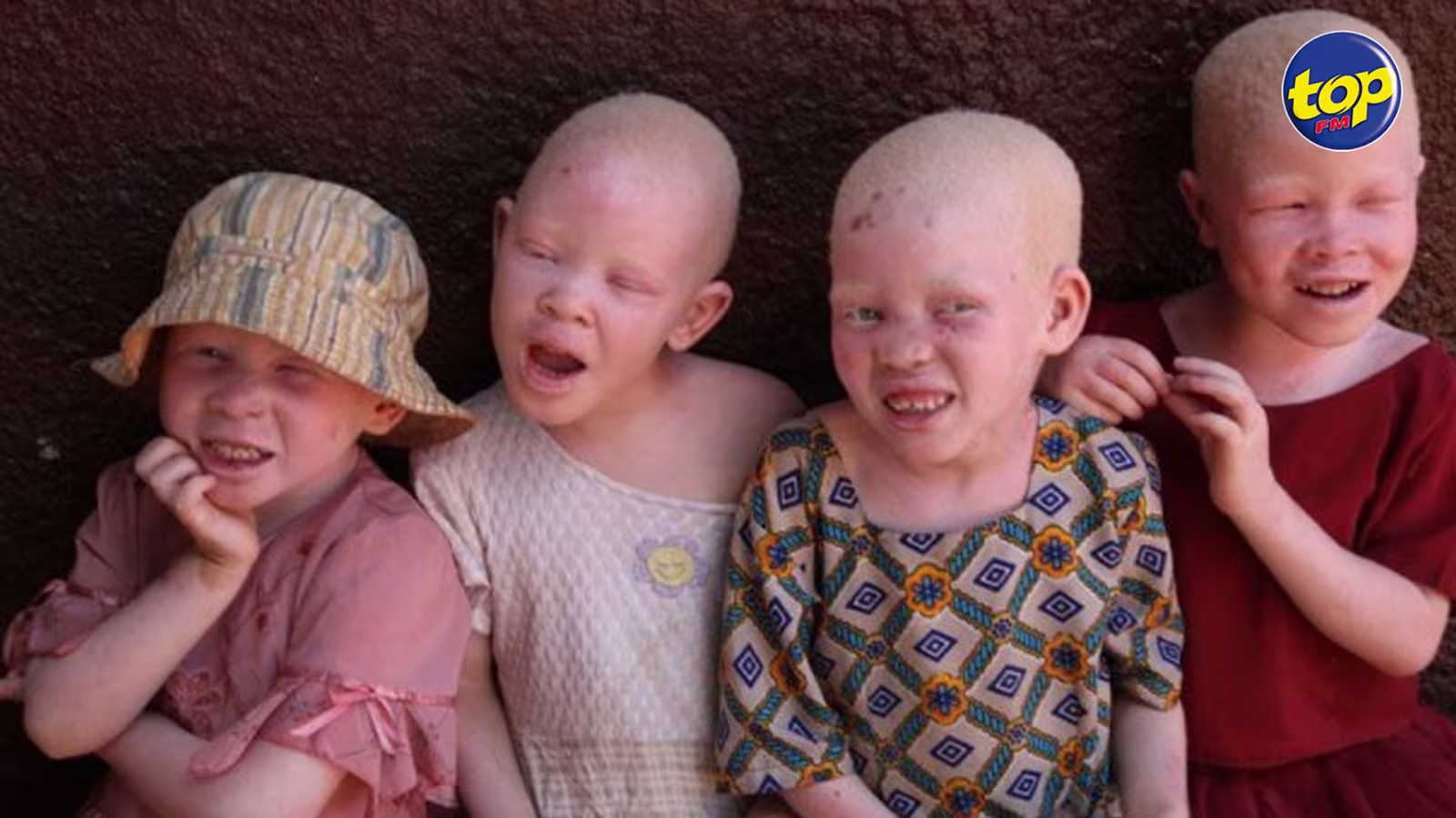 Région : les enlèvements d’albinos se multiplient Madagascar