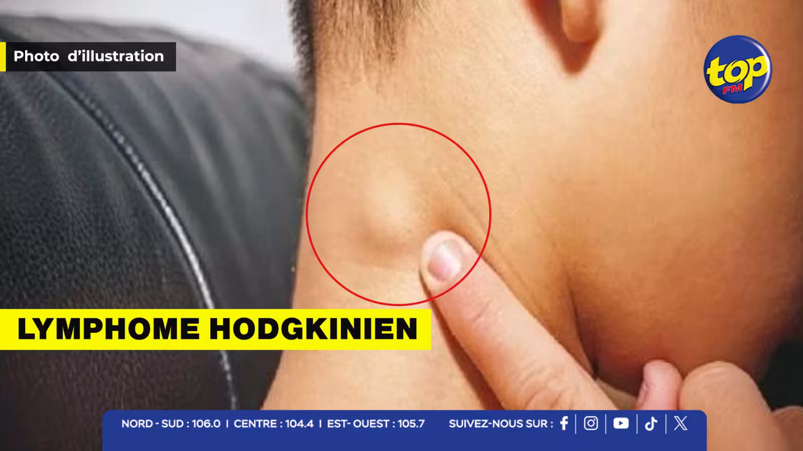 lymphome hodgkinien