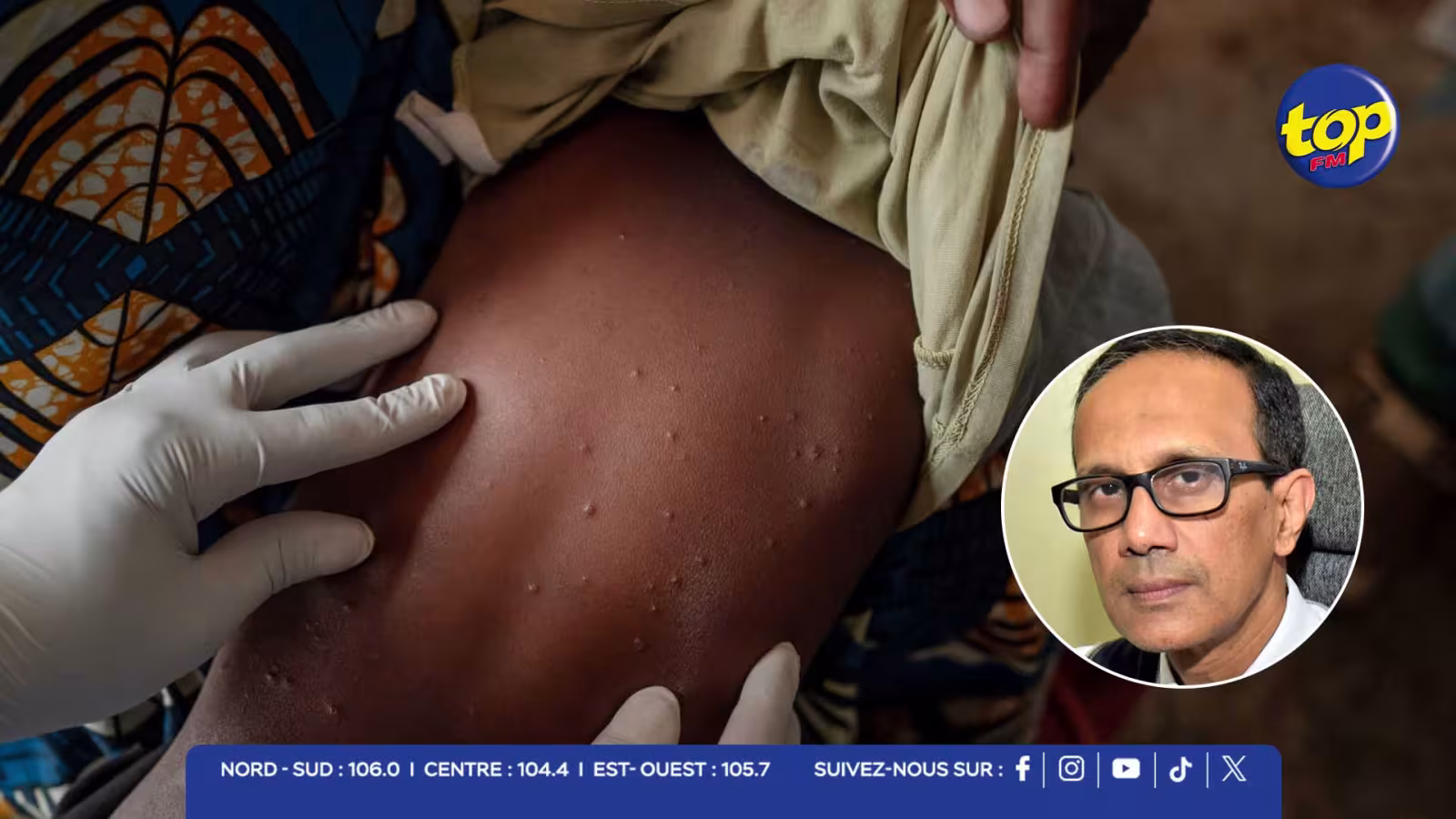 MPOX : Les autorités mauriciennes durcissent les mesures sanitaires face à la situation à Madagascar