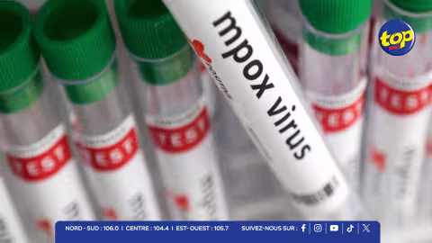Cinq cas de Mpox à Madagascar : surveillance accrue et protocoles renforcés à Maurice