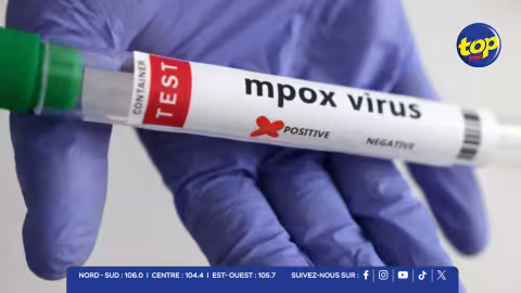 Mpox : un cas suspect placé en isolement à l’hôpital du Nord