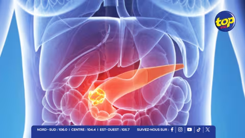 Cancer du pancréas : un simple comprimé quotidien pour contrer l’un des tueurs les plus redoutables