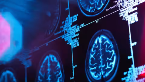 Enfin :  un médicament contre Alzheimer pour ralentir légèrement la maladie