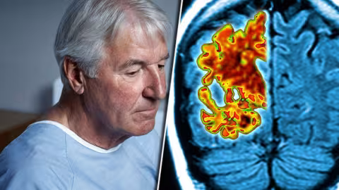 Percée historique contre la maladie d’Alzheimer : un médicament qui ralentit le déclin cérébral découvert