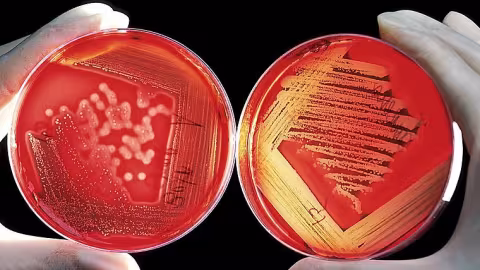 «Scénario cauchemardesque»: une infection fongique indestructible prolifère aux USA