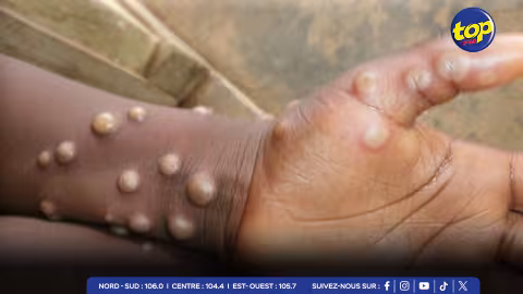 L’'épidémie de mpox s’aggrave en République démocratique du Congo :