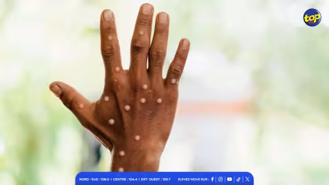 Mpox : Maurice renforce ses mesures de surveillance…Aucun cas détecté à ce jour