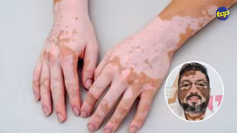 Journée mondiale du vitiligo : « Le manque d’éducation sur cette maladie fait que nombre d’ados et d’enfants qui en souffrent sont victimes de harcèlement », déplore Nitish Nalam Nastili, fondateur de la Vitiligo Mauritius Foundation