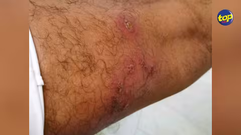 Quatre cas de la variole du singe détectés dans l’océan Indien : l’île de la Réunion démarre sa campagne de vaccination