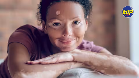 Un traitement contre le vitiligo approuvé en Europe