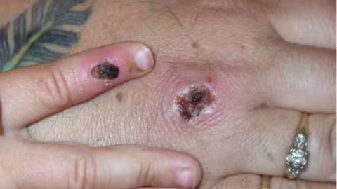 La variole du singe se répand de façon «rare et inhabituelle» en GB