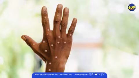 Mpox : « Des consignes sanitaires édictées pour les Mauriciens se rendant dans les pays à risque », annonce le Dr Fazil Khodabocus