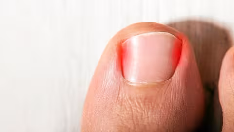 Astuces pour eviter les ongles incarnés