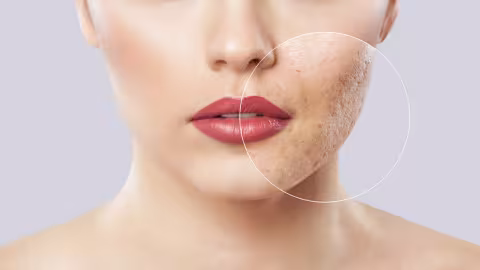 Comment lutter contre la peau grasse