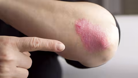 Journée Mondiale du psoriasis